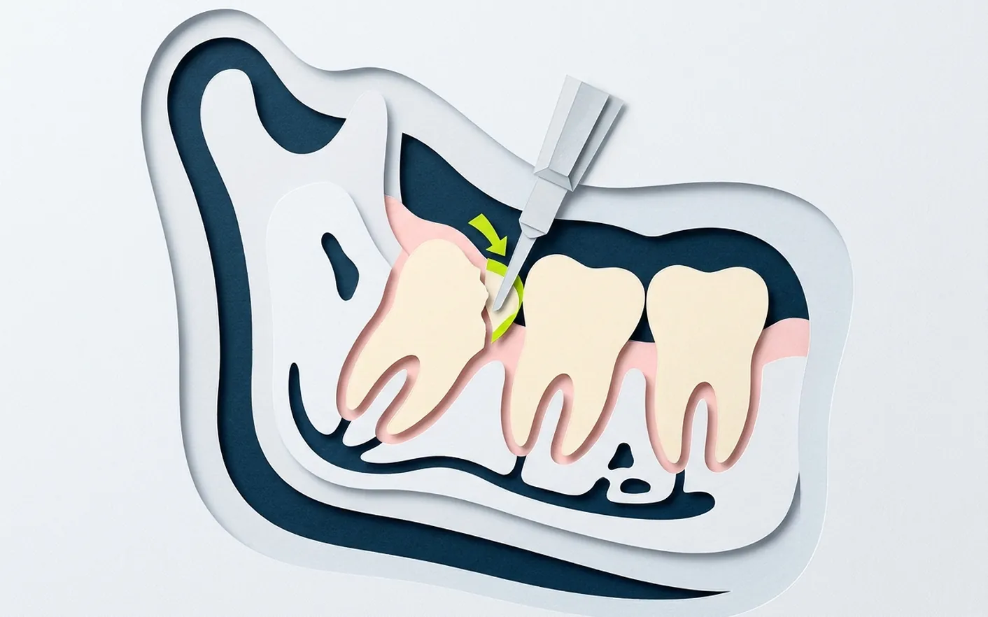 Come si svolge l'estrazione di un dente e quale anestesia si usa? Foto dello studio di Via Posarelli.