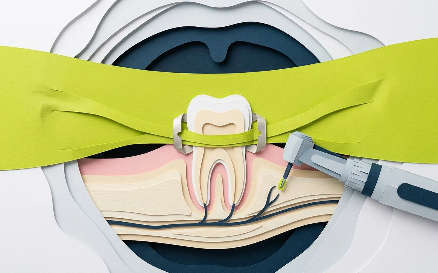 Come si ricostruisce un dente con l'otturazione? Foto dello studio di Via Posarelli.