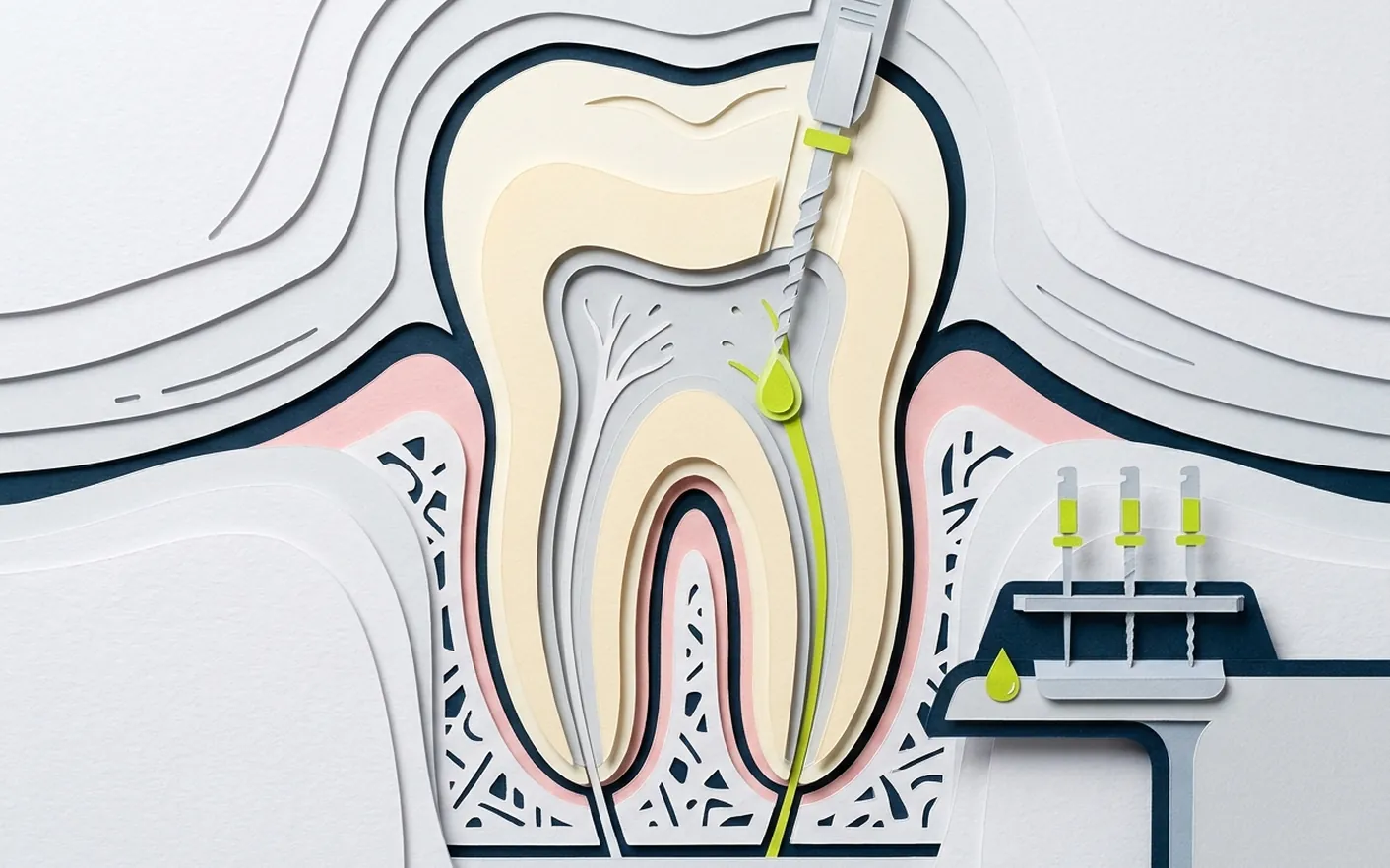 Quando serve la devitalizzazione di un dente? Foto dello studio di Via Posarelli.