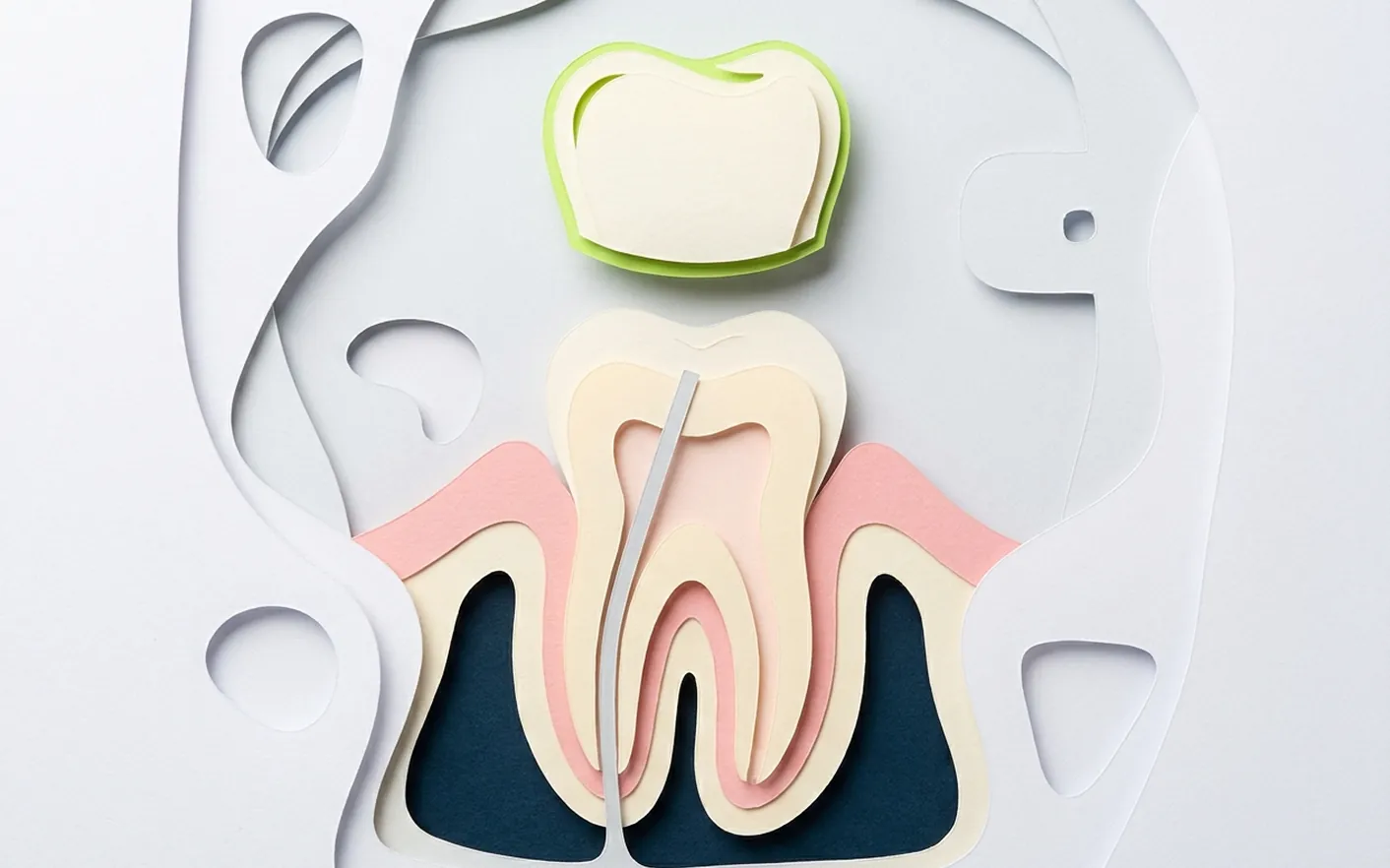 Cosa succede al dente dopo la devitalizzazione? Foto dello studio di Via Posarelli.
