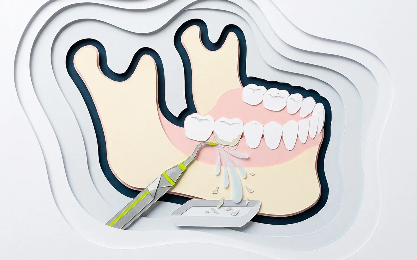 Cosa succede in una seduta di pulizia dei denti? Foto dello studio di Via Posarelli.