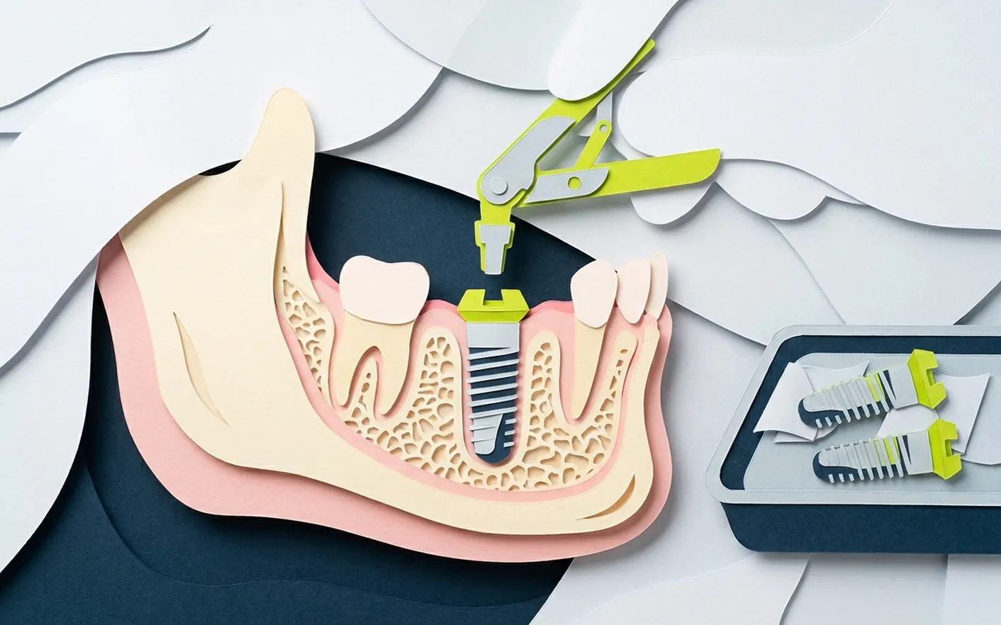 Quando ha senso mettere un impianto dentale? Foto dello studio di Via Posarelli.