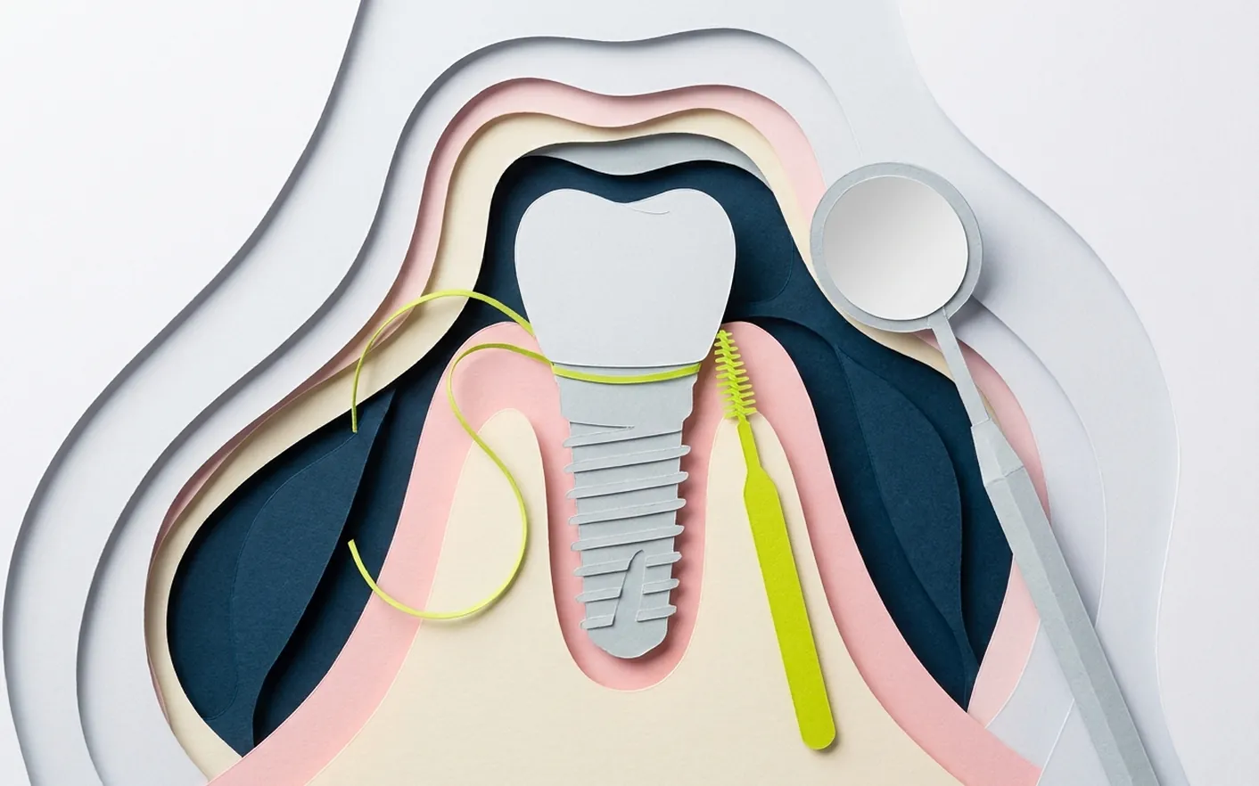 Cos'è la perimplantite e quali sono i segnali? Foto dello studio di Via Posarelli.