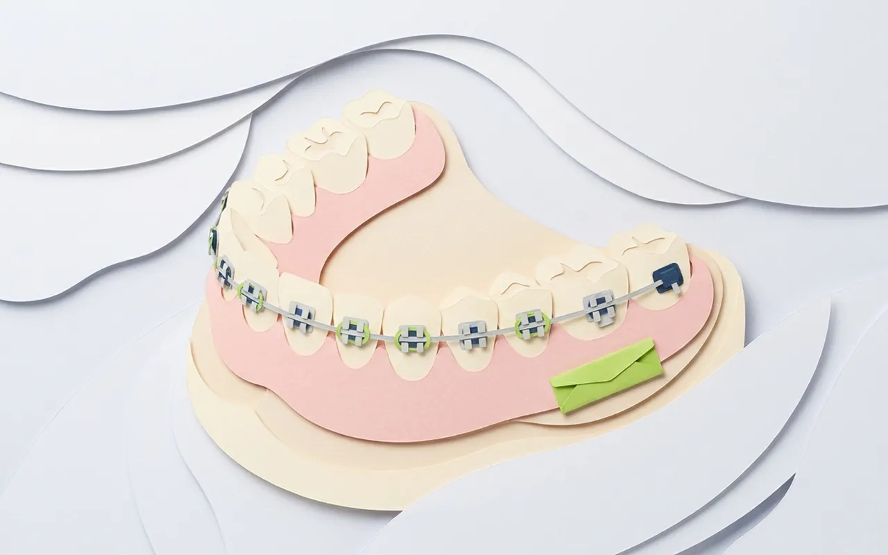 Apparecchio esterno denti con attacchi vestibolari applicati nello studio di Castelfranco di Sotto