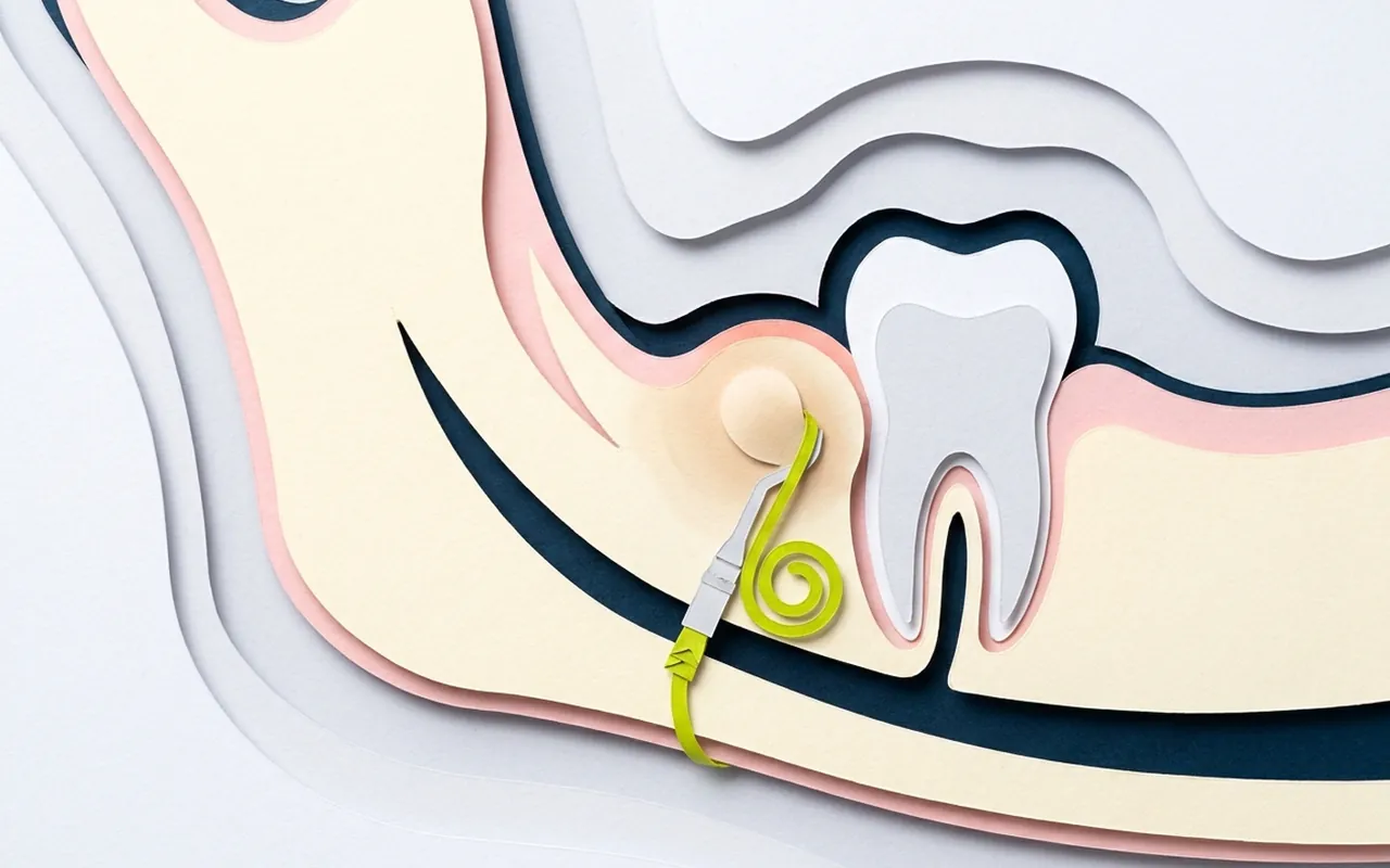 Ascesso dentale quanto dura: la cura dell'ascesso nello studio dentistico di Castelfranco di Sotto
