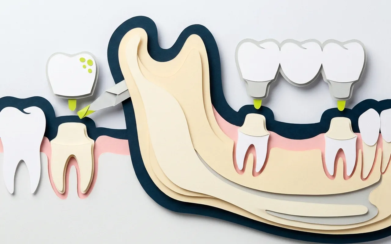 Corona in ceramica pronta per incapsulare un dente nello studio di Castelfranco di Sotto