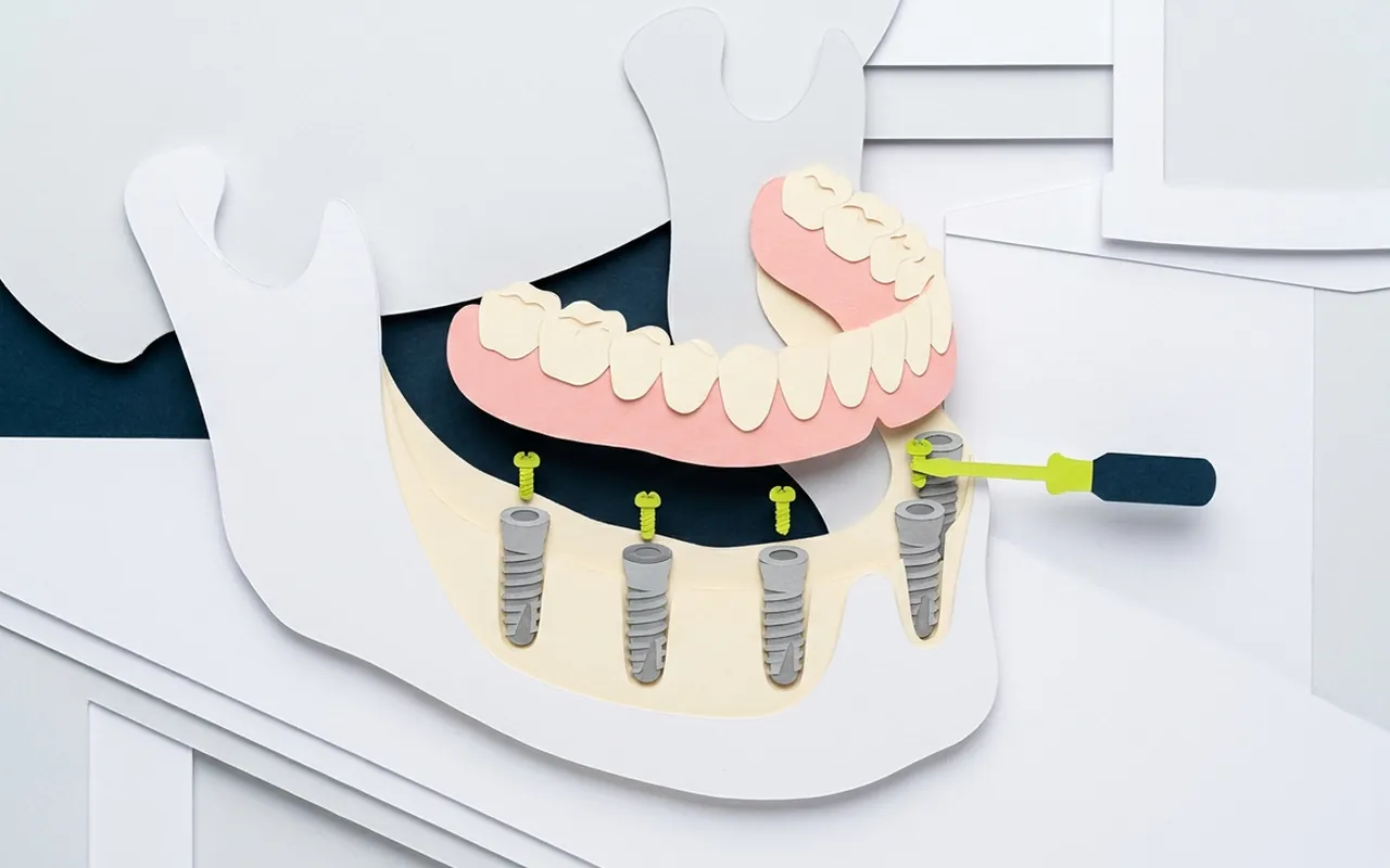 Protesi fissa su impianti che illustra il costo dentiera fissa completa nello studio di Castelfranco di Sotto