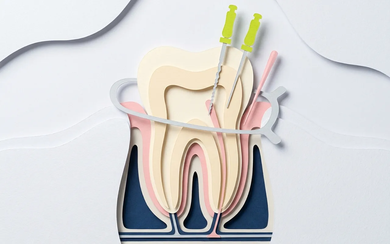 Come si devitalizza un dente: strumenti di endodonzia pronti nello studio di Castelfranco di Sotto