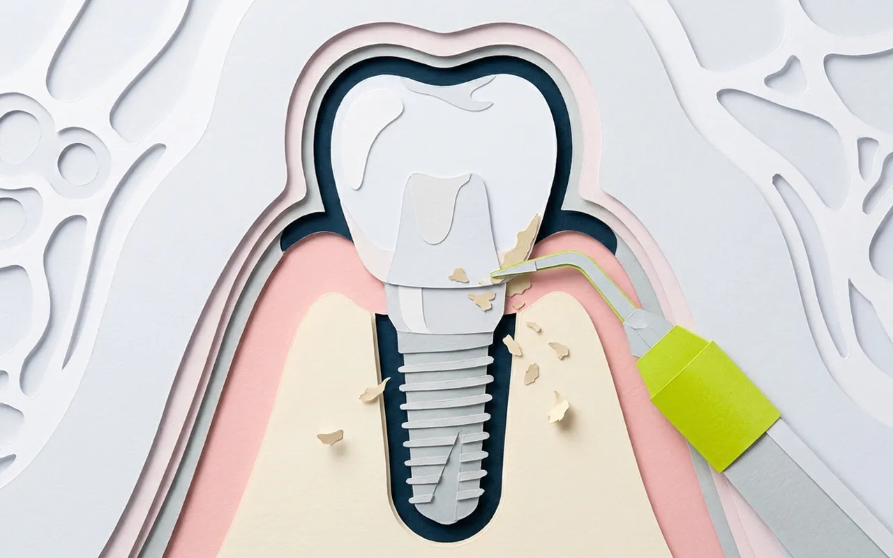 Strumenti per la pulizia impianti dentali fissi nella sala dello studio di Castelfranco di Sotto