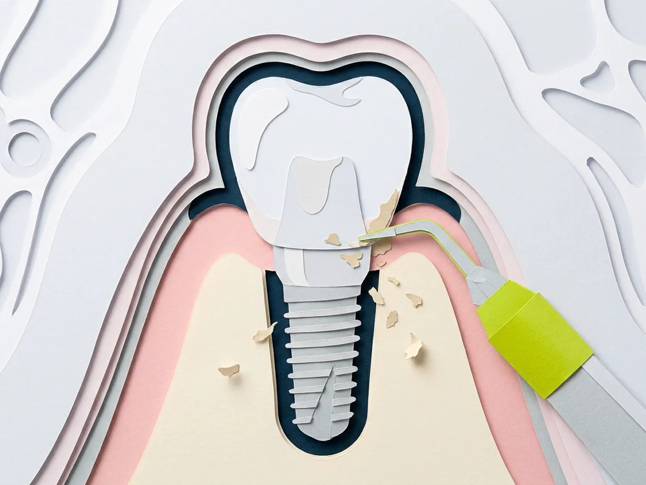 Pulizia impianti dentali a Castelfranco di Sotto: le assistenti dello studio di Via Posarelli