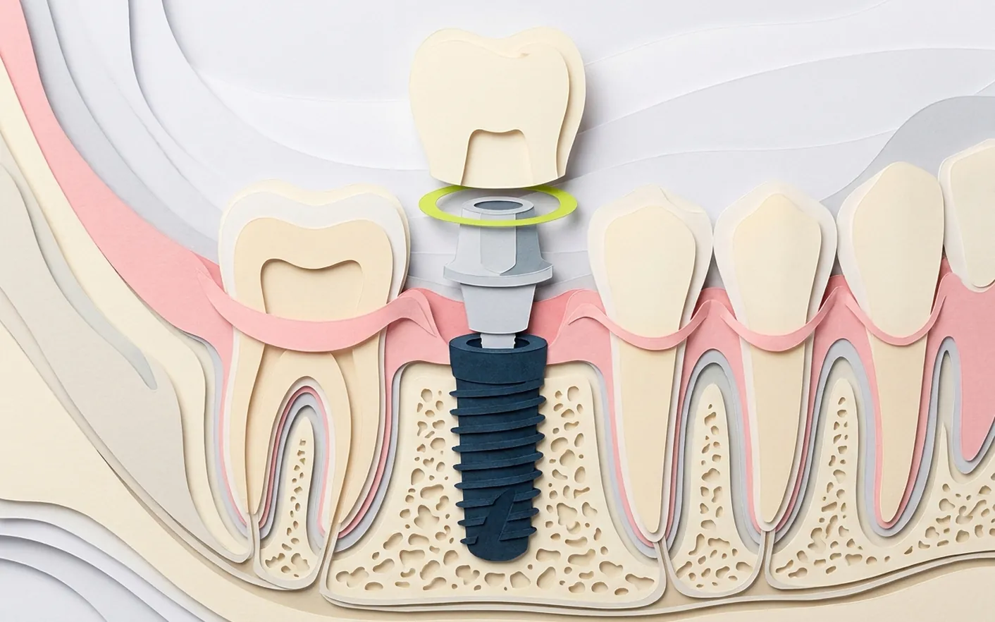 Implantologia dentale a Castelfranco di Sotto