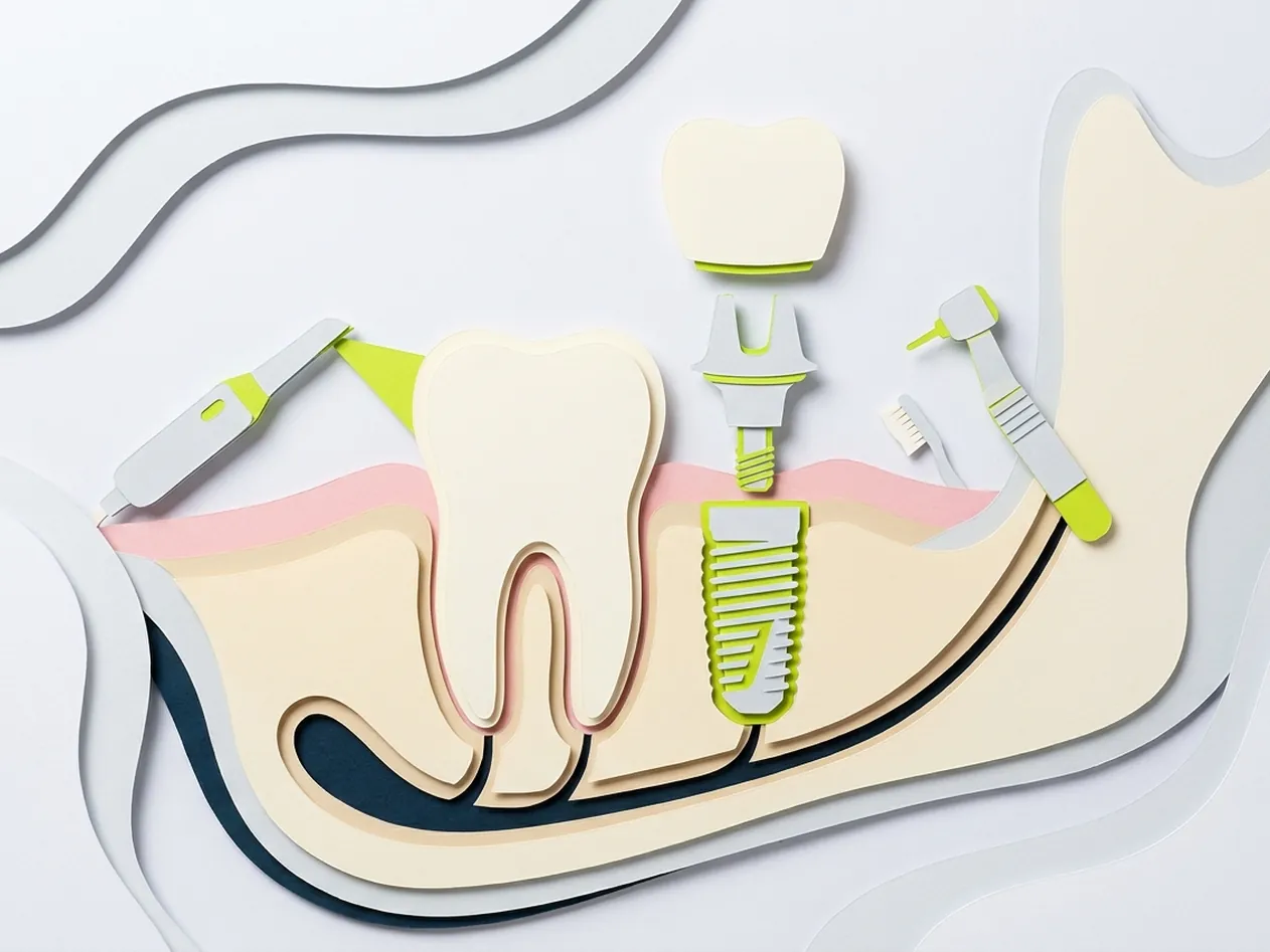 Diorama in miniatura di tutti i trattamenti: piccola esposizione con impianto, corona, faccetta, dente in sezione e scanner